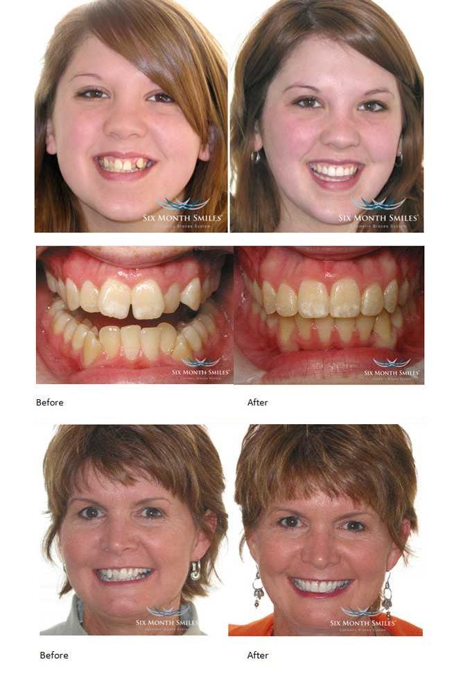 Six Month Smiles Cockfosters Azamay Dental And Skin Clinic London