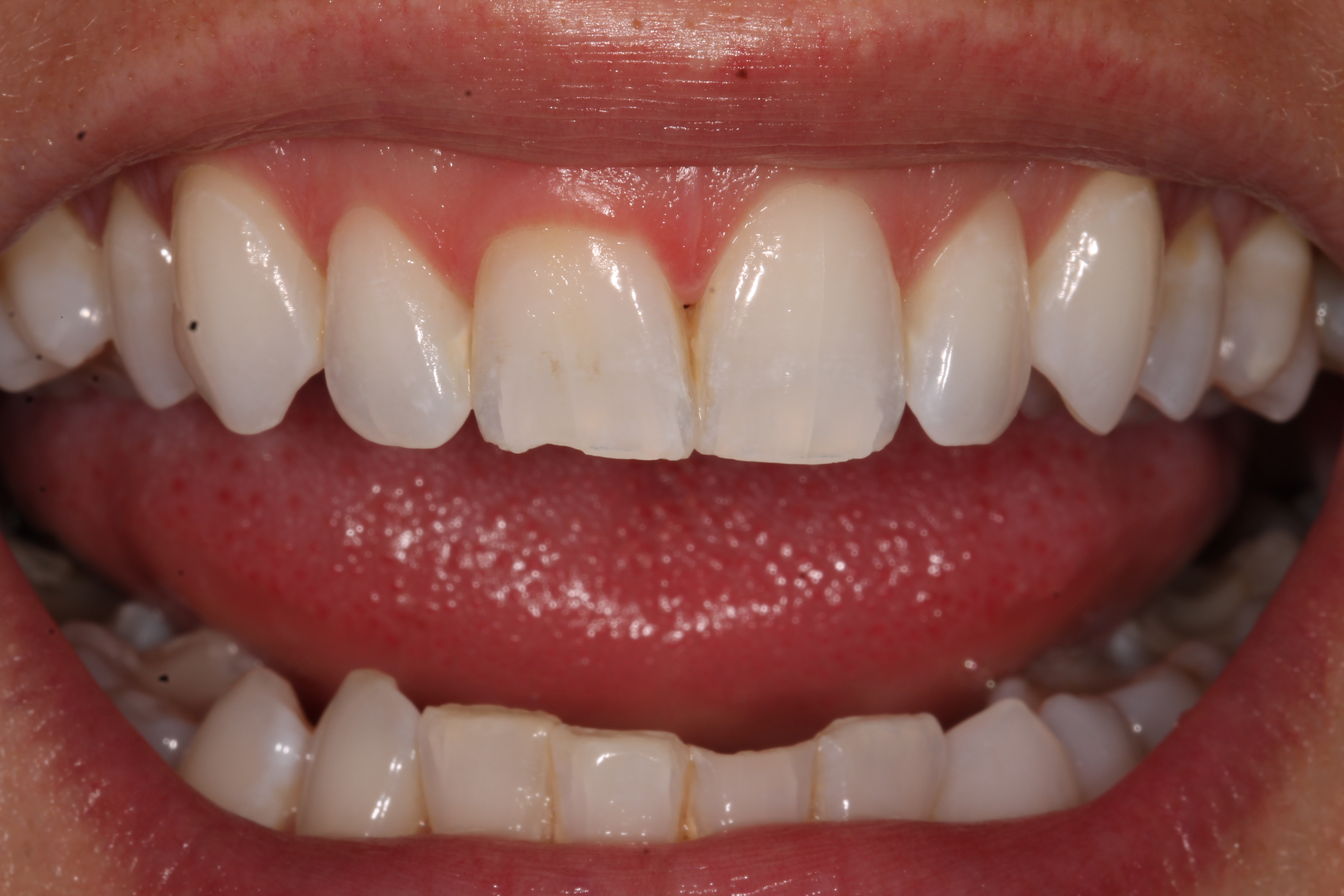 White Tooth Fillings, Dental & Composite Bonding Treatments London