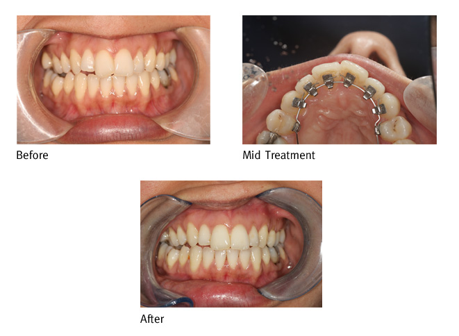 Lingual Braces: How it Works, Cost, Before and After Images