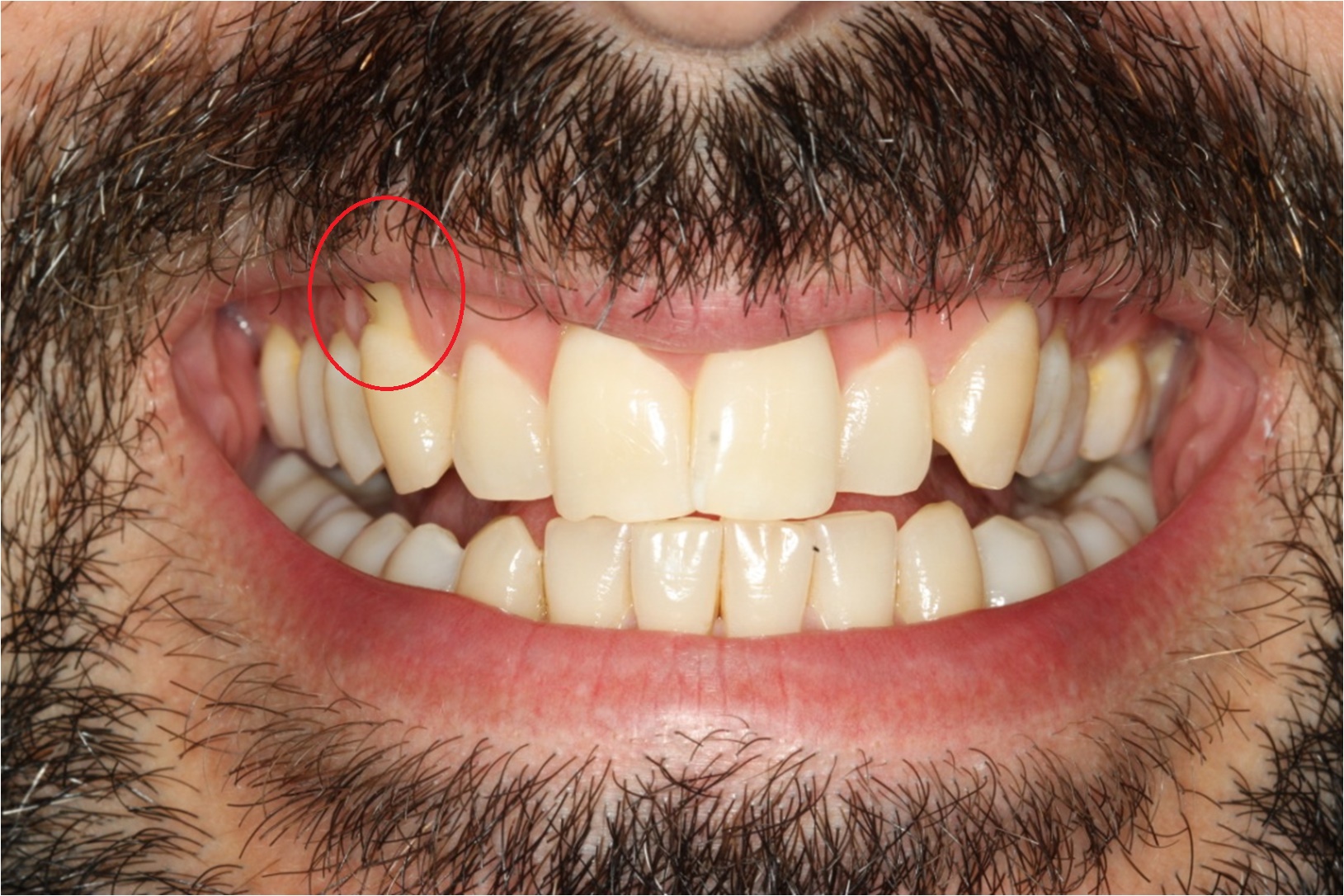 how can i fix my receding gums at home