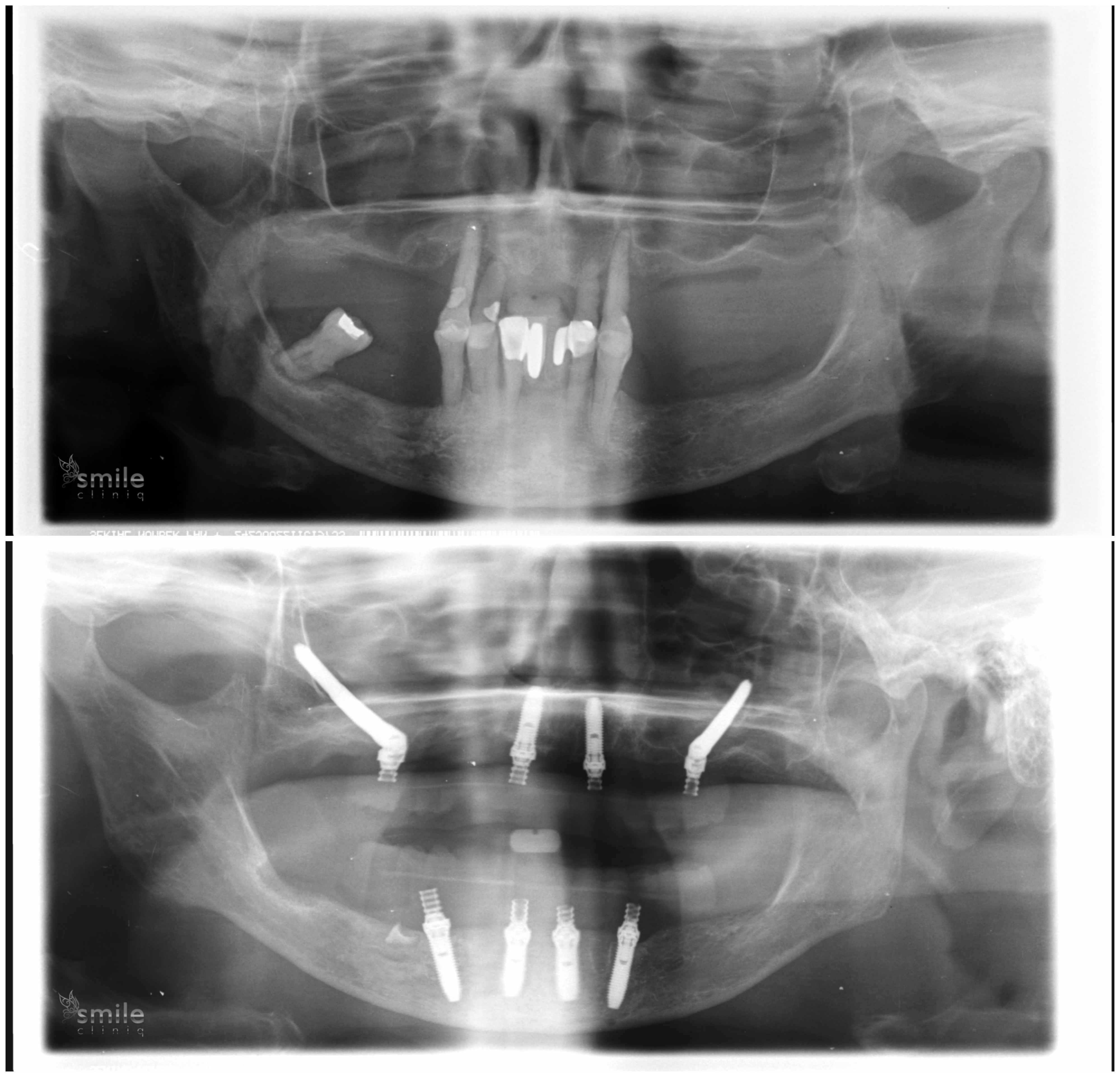 dental implant