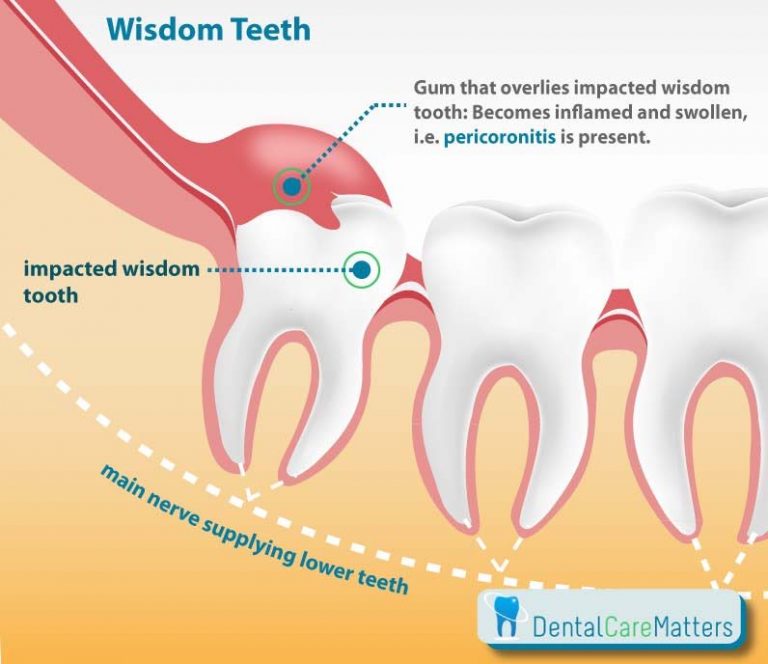 Pericoronitis Laser Treatment in London, Book A Consultation