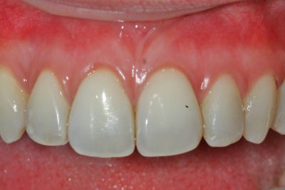 Receding Gums Treatments Gum Graft Reverse Receding Gums