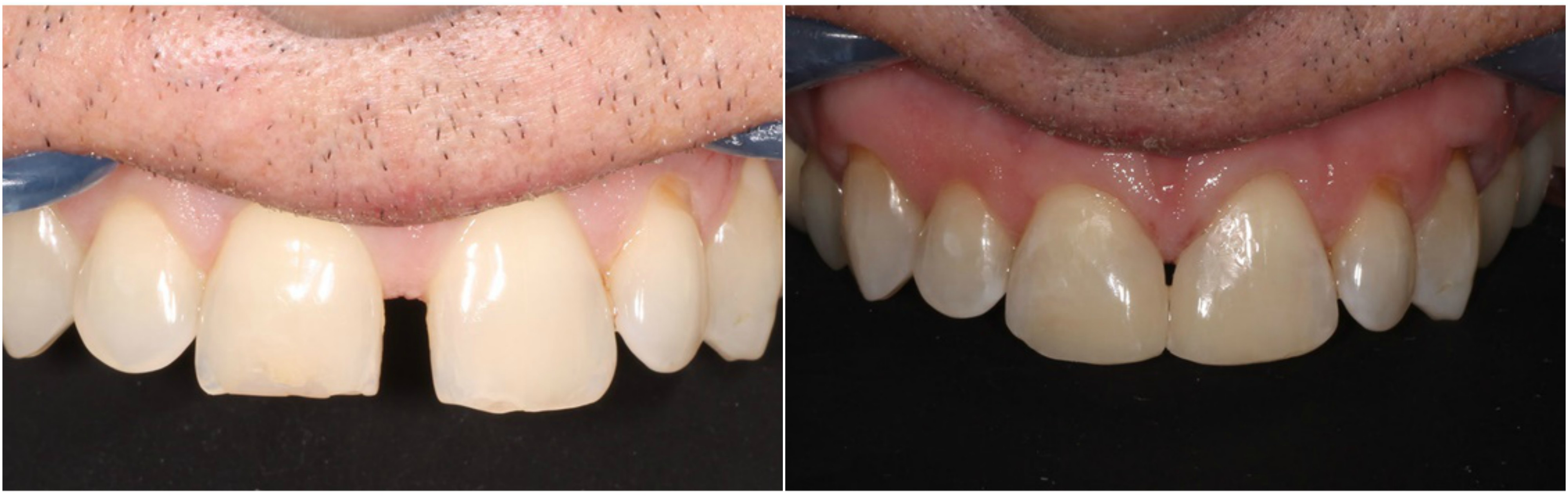 Diastema, Bioclear Matrix, Diastema Closure London