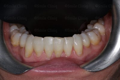 Lower teeth Black Triangle Treatment after