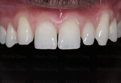 bioclear composite makeover before