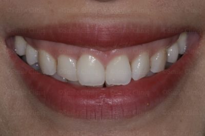 multiple bioclear after