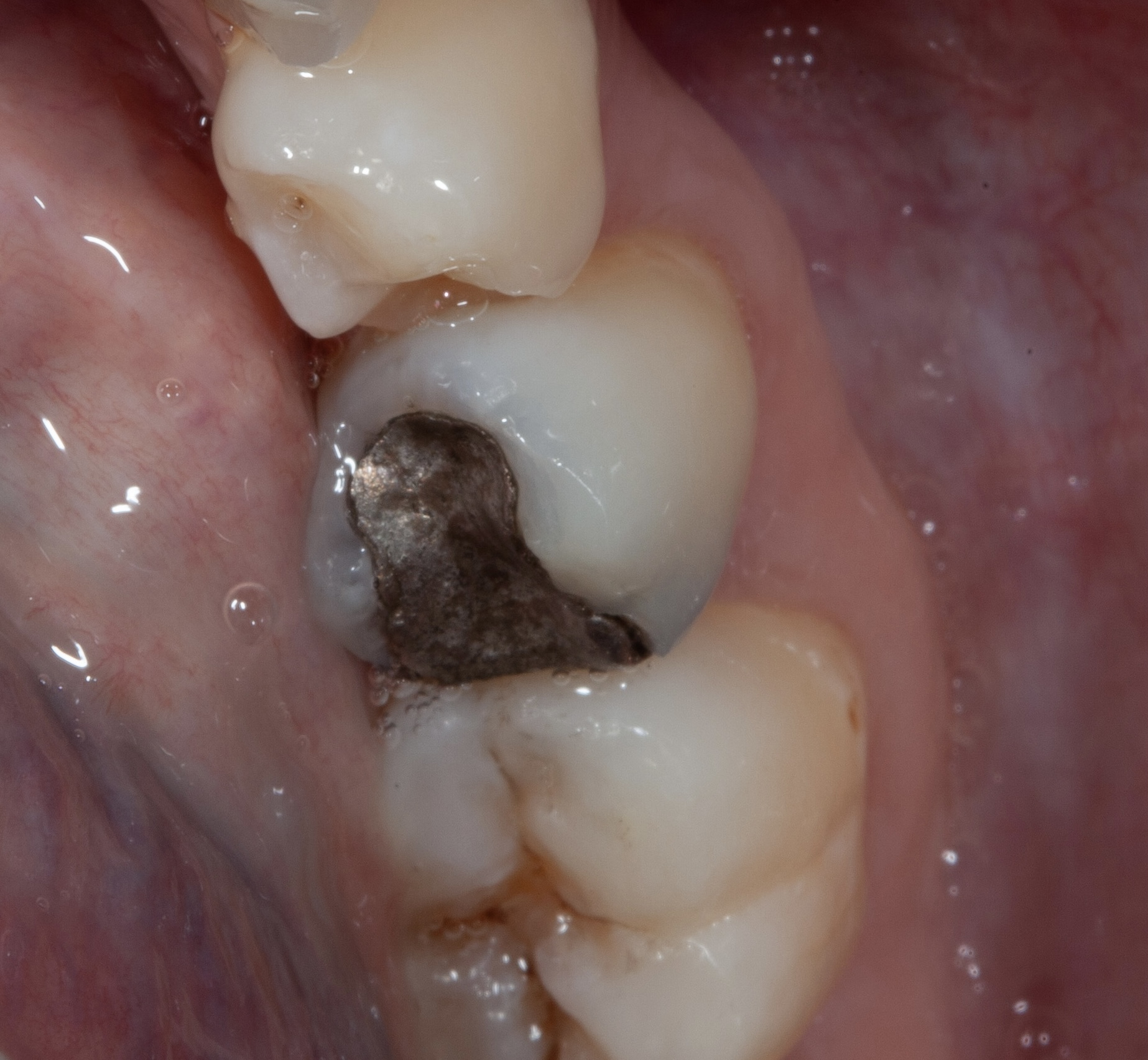 Should I Replace My Amalgam Fillings? Smile Cliniq