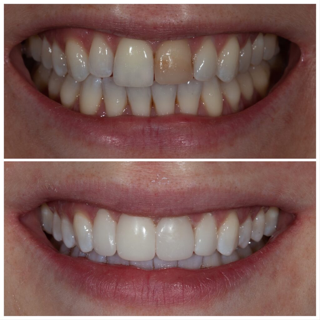 Treating Discoloured Teeth With Composite Bonding Smile Cliniq 1749